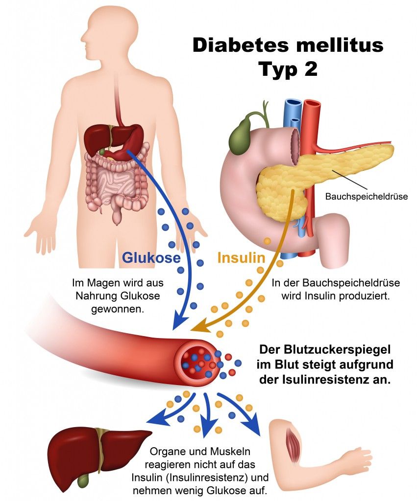 Diabetes Mellitus: Symptome, Ursachen Und Behandlung