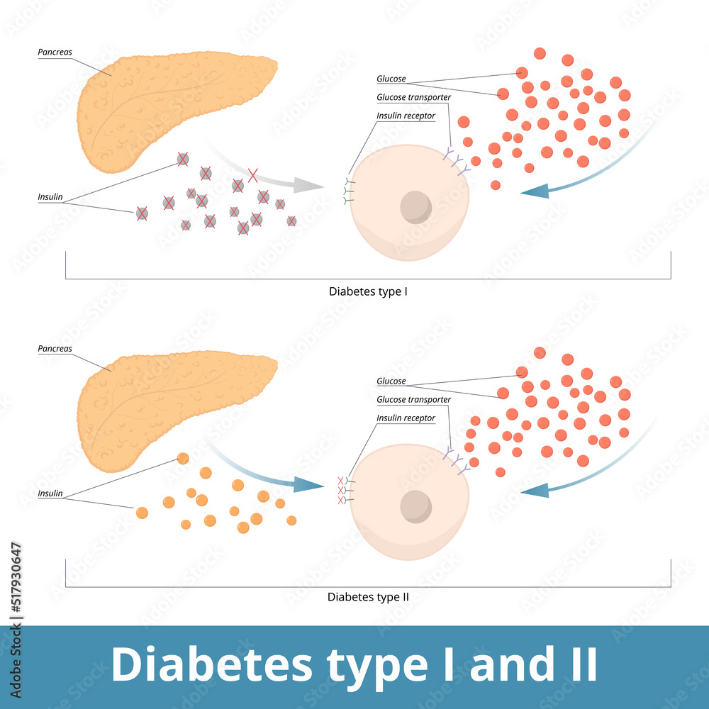 Pankreoprive Diabetes Mellitus: Ein Umfassender Einblick