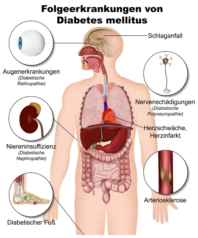 Diabetes Mellitus: Ein Komplexes Krankheitsbild Mit Weitreichenden Folgen