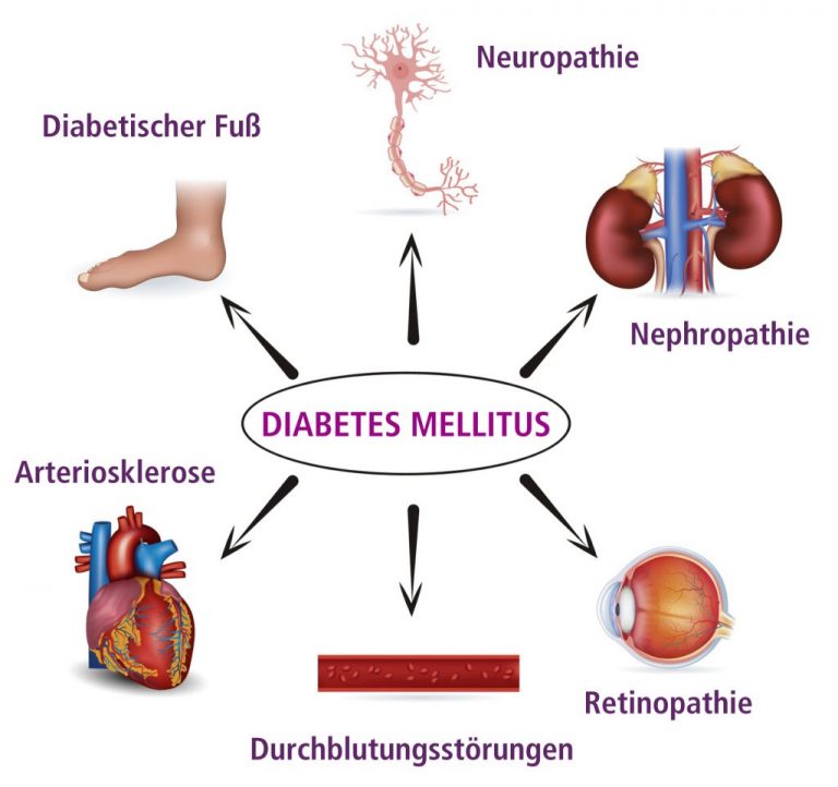 Diabetes Mellitus: Lebenserwartung Und Einflussfaktoren