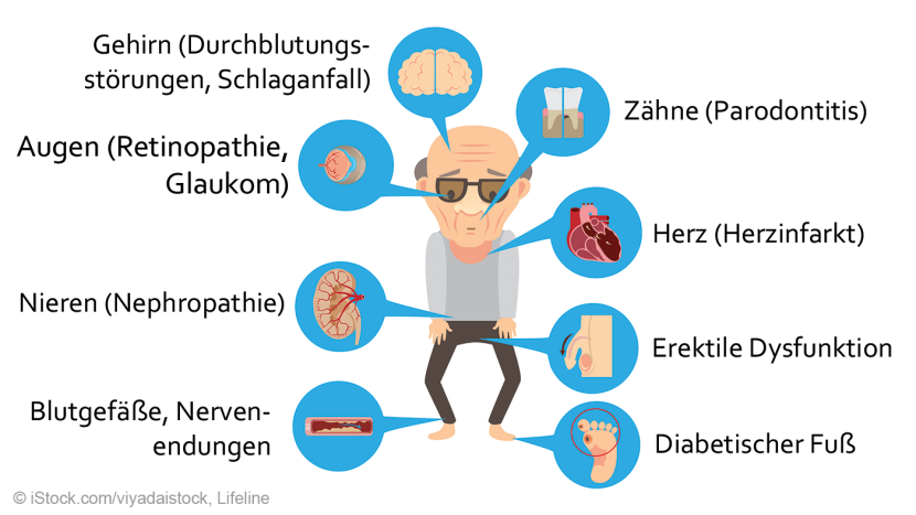 Diabetes Mellitus: Eine Chronische Erkrankung Mit Weitreichenden Komplikationen