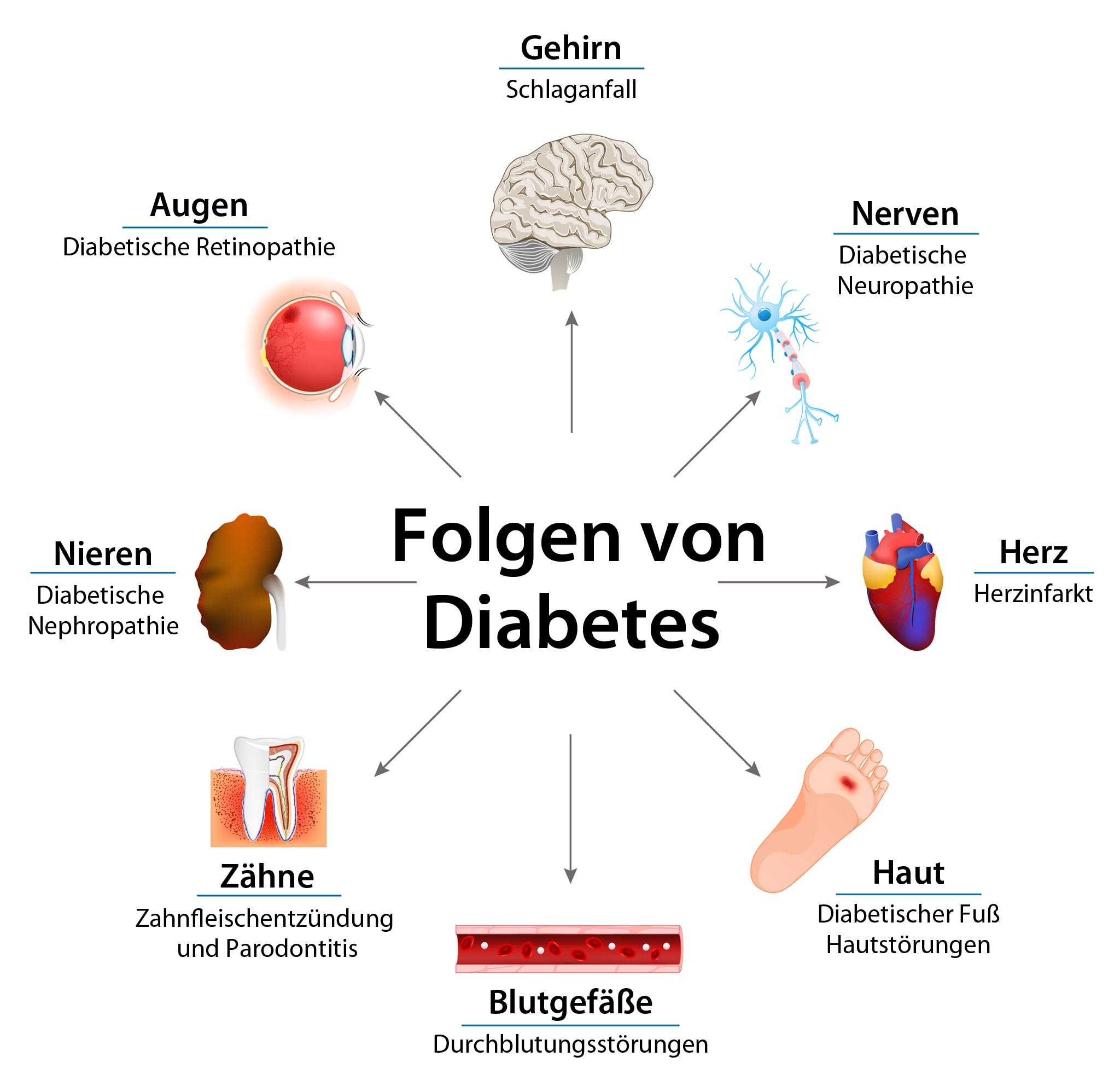 Diabetes Mellitus: Ein Überblick über Die Krankheit, Ihre Diagnose Und Behandlung