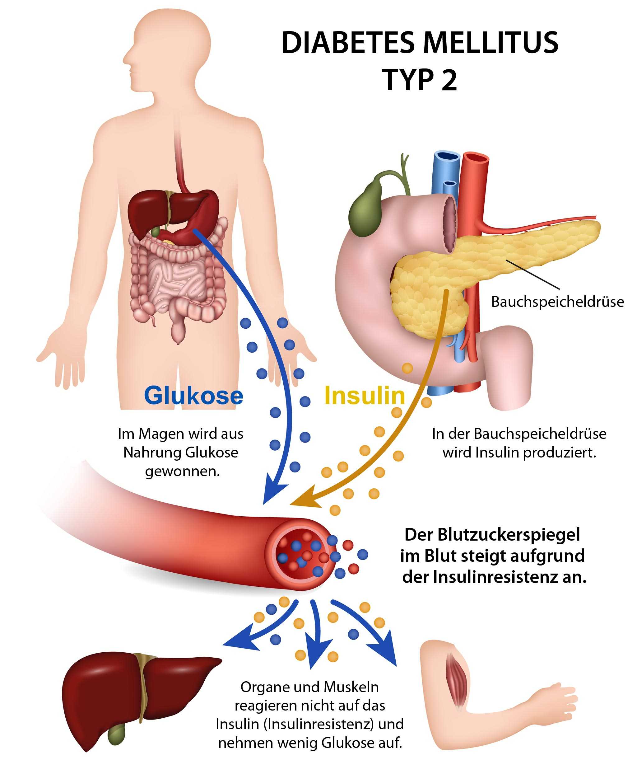 Diabetes Mellitus Typ 2: Eine Komplexe Erkrankung Mit Stetiger Zunahme