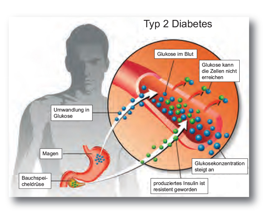 Nicht Insulin-abhängiger Diabetes Mellitus (Typ 2): Eine Komplexe Erkrankung Mit Vielfältigen Auswirkungen