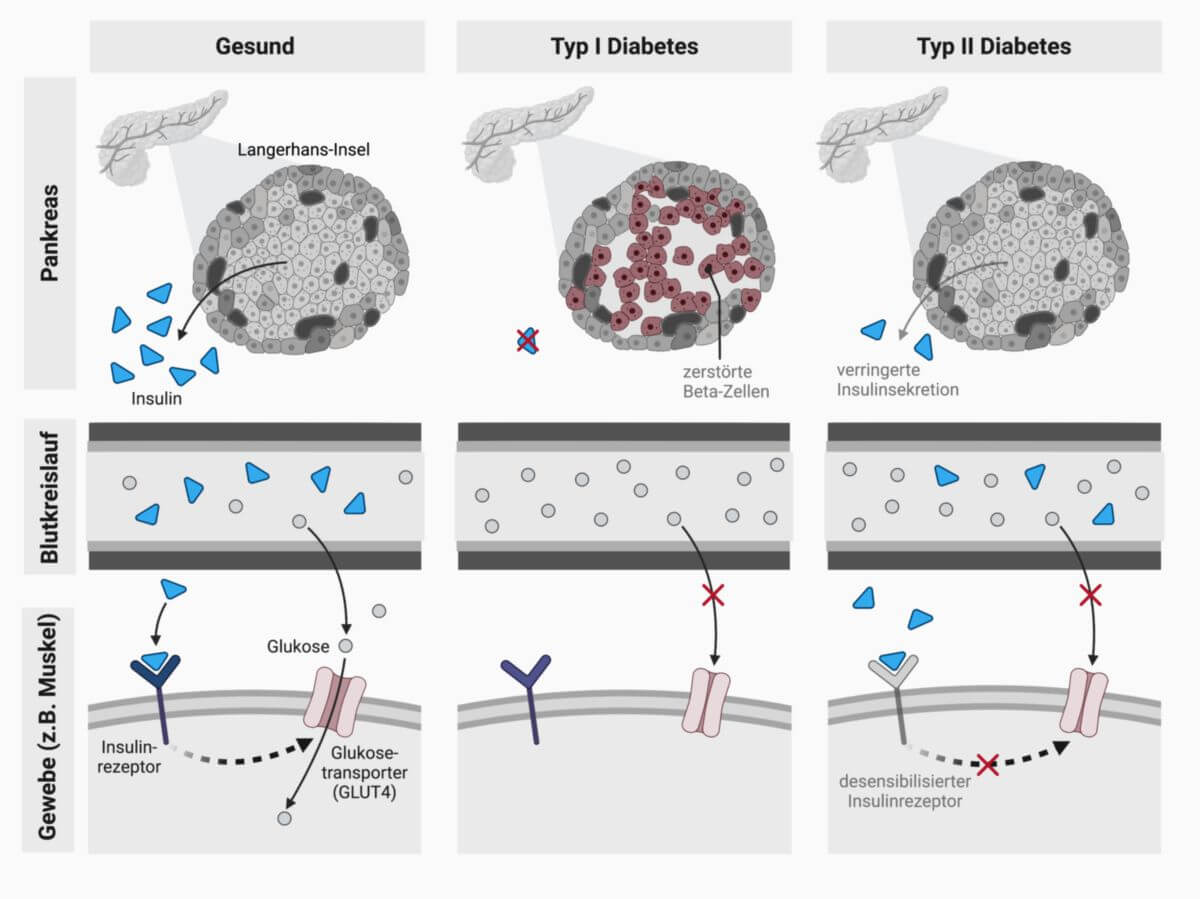 Diabetes Mellitus Typ 1: Eine Chronische Krankheit Im Kindesalter