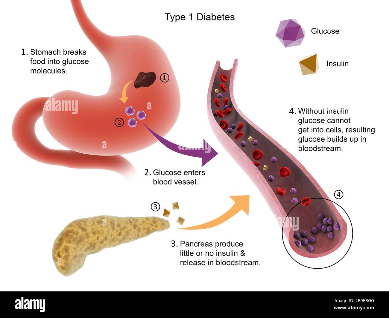 Diabetes Mellitus Typ 1: Eine Komplexe Erkrankung